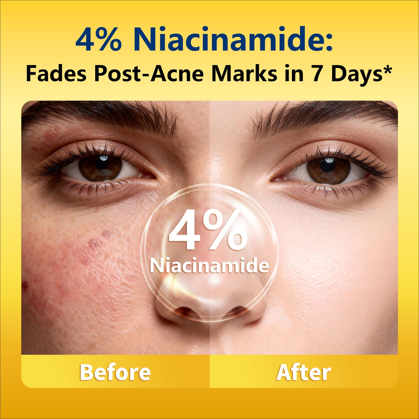 Drying Lotion Plus – Visibly Shrink Pimples in 24 Hours & Fade Dark Spots in 7 Days | 20ml